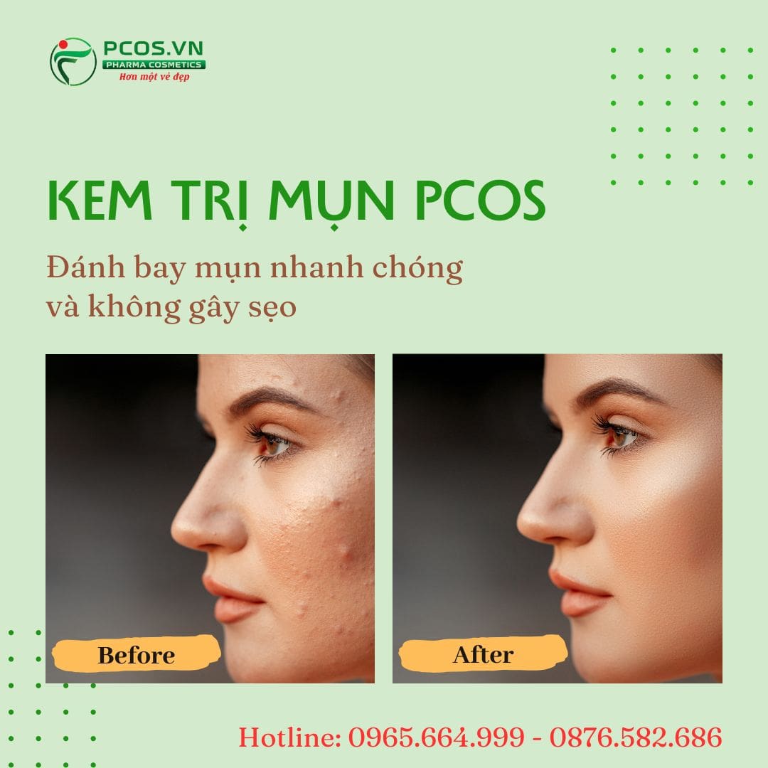 Sản phẩm kem trị mụn nhanh không gây sẹo